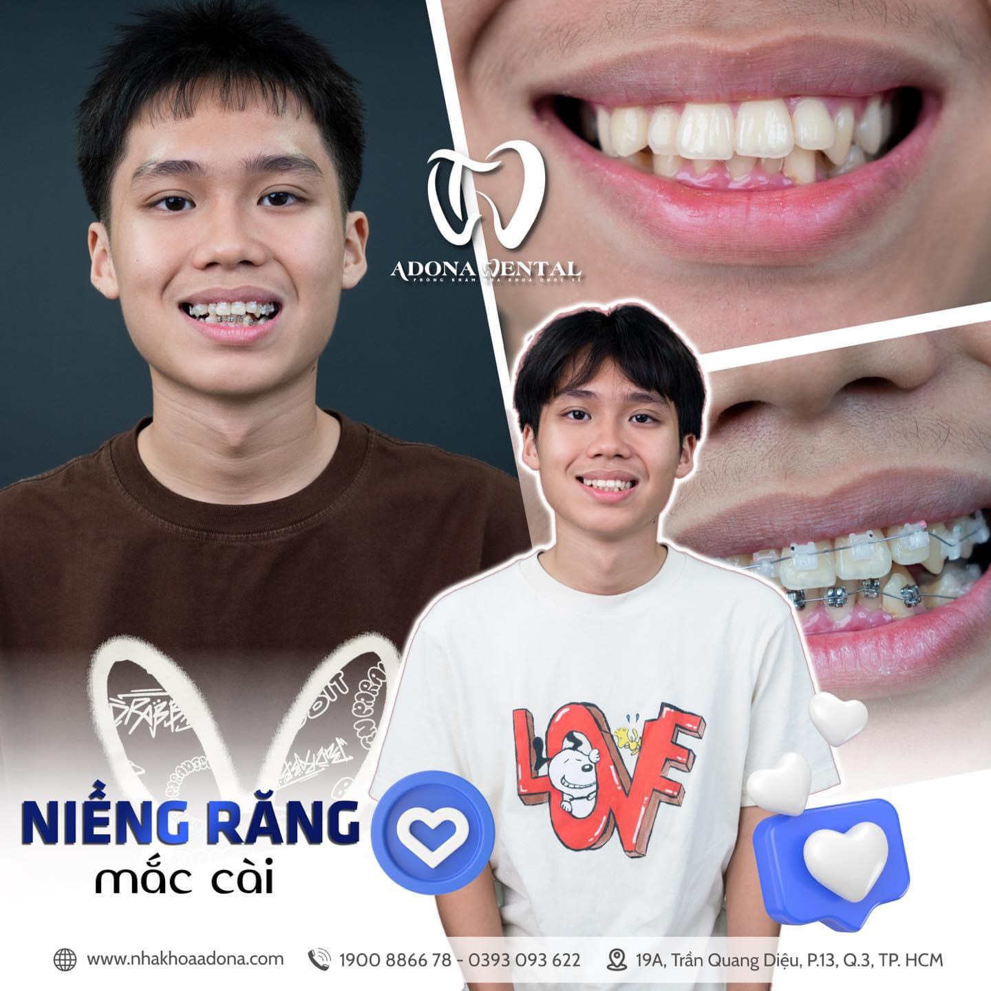 Niềng Răng: Quyết Định Quan Trọng Đối Với Nụ Cười Hoàn Hảo và Sức Khỏe ...