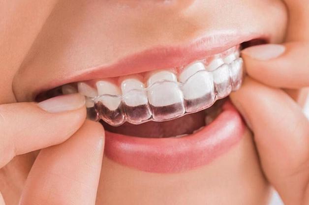 Chỉnh nha khay invisalign