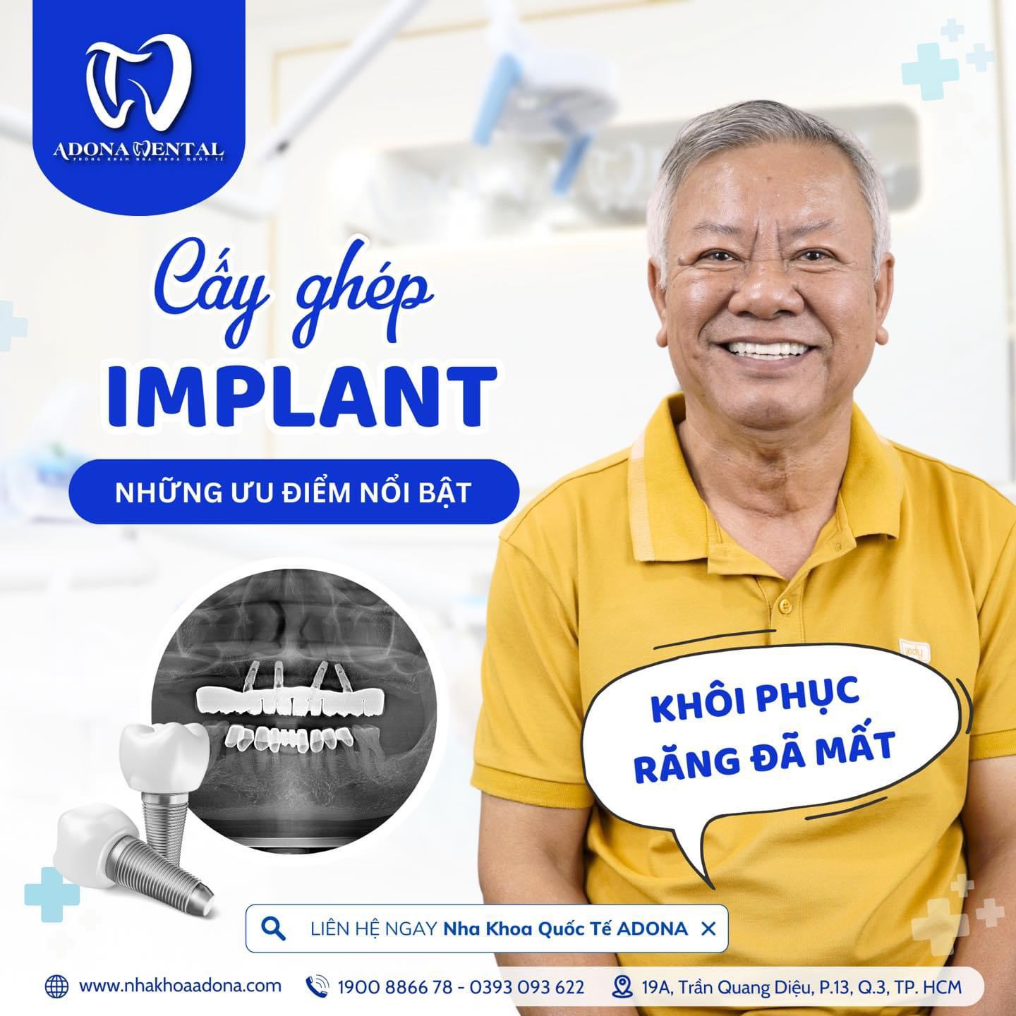 Trồng Răng Implant