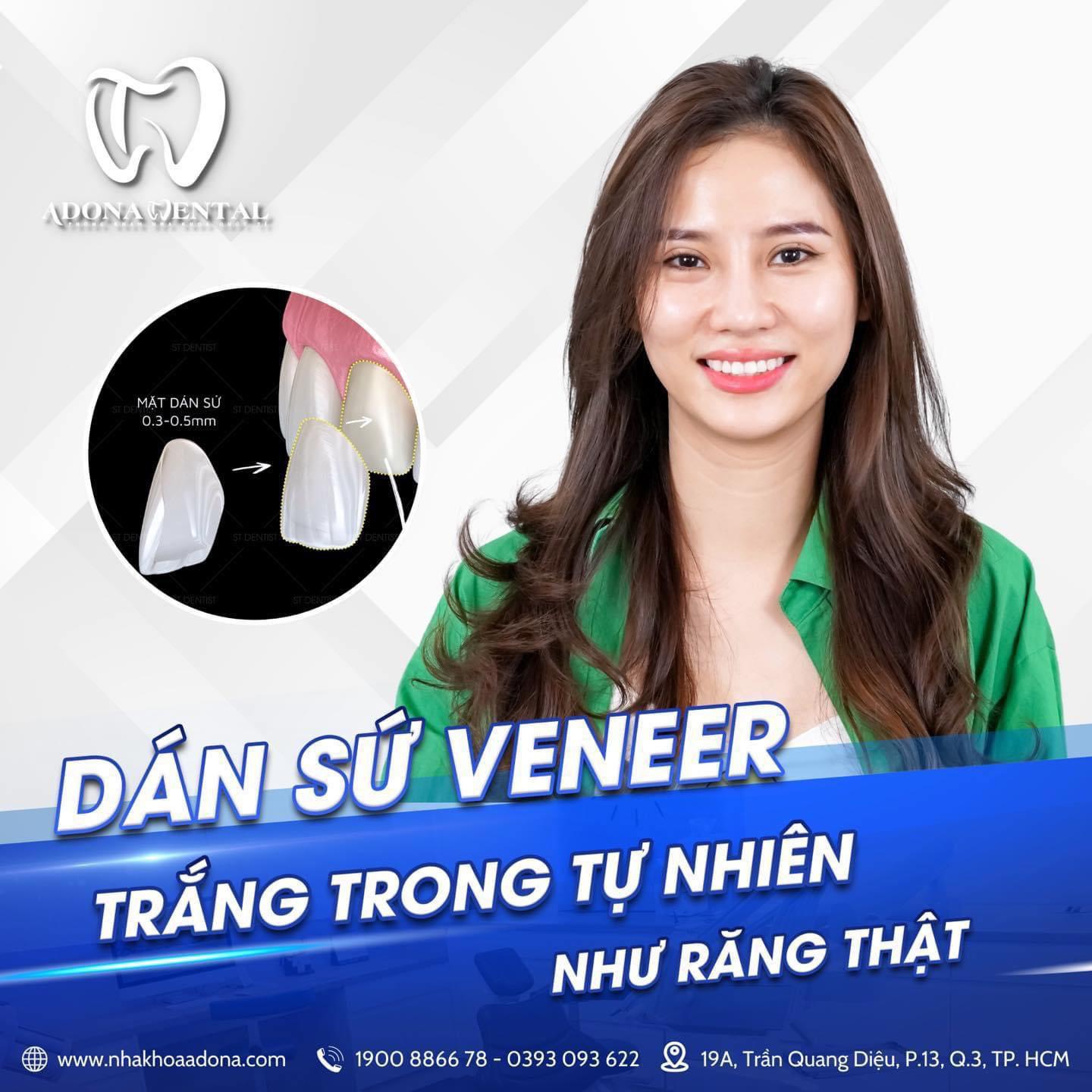 Dán sứ Veneer